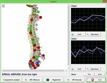d-pro-analysis_with_nidus-results-spinal_nerves_enl